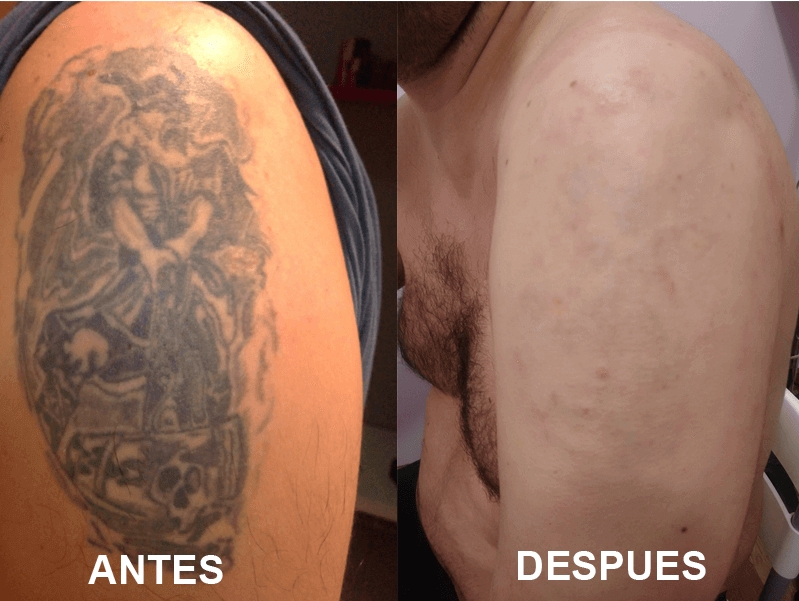 ▷ Borrar y eliminar tatuajes en Lugo (Galicia) 2019 - Camaleon Tattoo