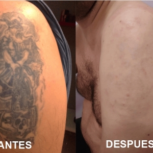 Borrado y eliminación de tatuajes 0