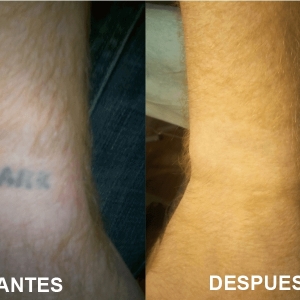 Borrado y eliminación de tatuajes 1