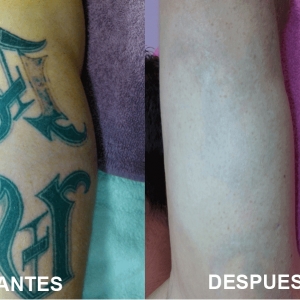 Borrado y eliminación de tatuajes 2